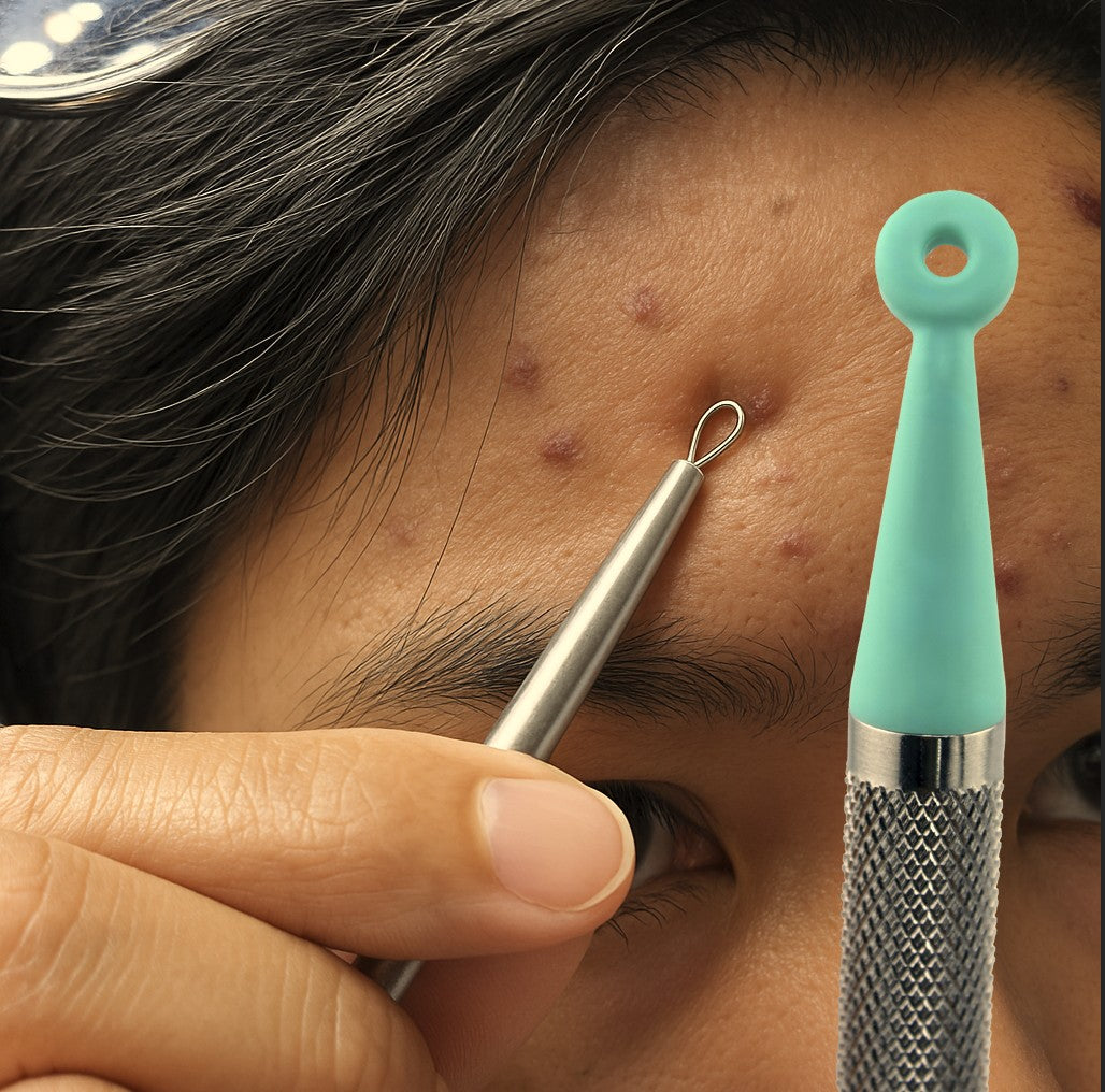 Metal Comedone Extractor Pain Try Halo SoftSqueeze Instead